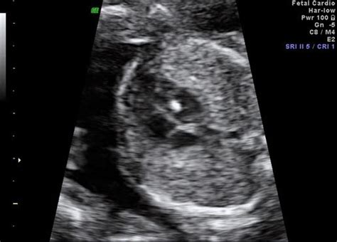Detaylı ultrasonda kalpte delik